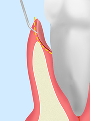 歯周ポケット掻把（そうは）術