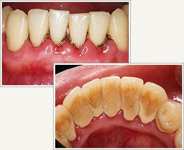 歯周病は歯を失う原因の第一位です