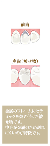 セラミックス＋金属