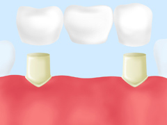 ブリッジ治療について