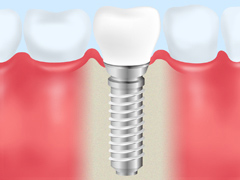 当クリニックのインプラント治療について