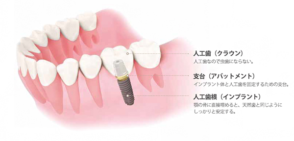 歯を失ってしまったときの選択肢は3つあります