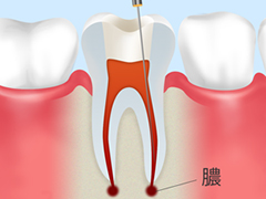 歯の根っこの治療