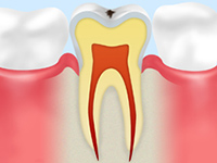 虫歯の進行の流れと治療法