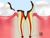 C4：歯根まで達した虫歯