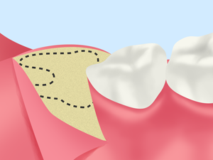 親知らずの抜歯の流れ STEP02