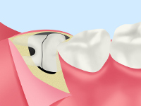 親知らずの抜歯の流れ STEP04