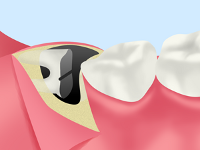 親知らずの抜歯の流れ STEP05