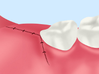 親知らずの抜歯の流れ STEP06