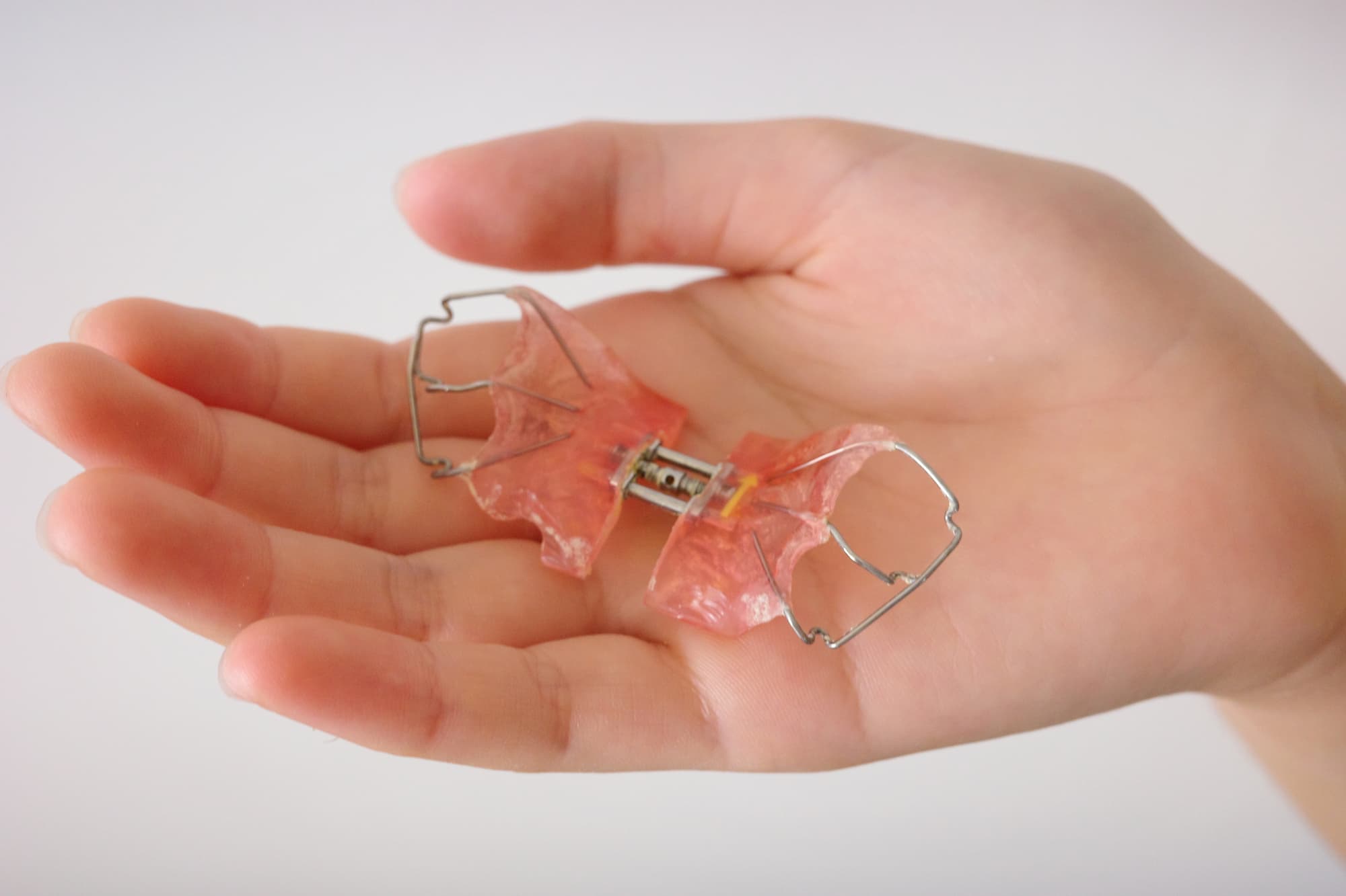 子どもの受け口に使用する床矯正の装置